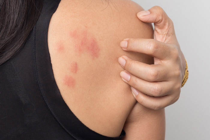 Seasonal Skin Allergy Epidemic